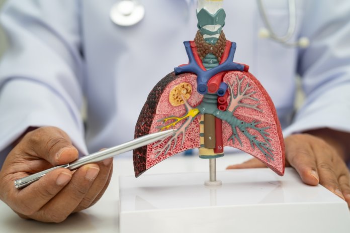 Pneumonia,,Lung,Cancer,,Asian,Doctor,Holding,Human,Anatomy,Model,For